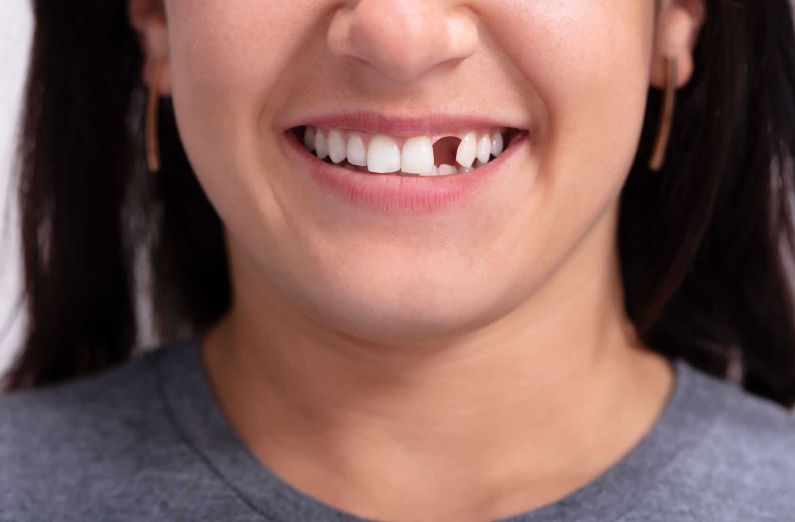 Close-up of a person with a missing tooth smiling confidently.