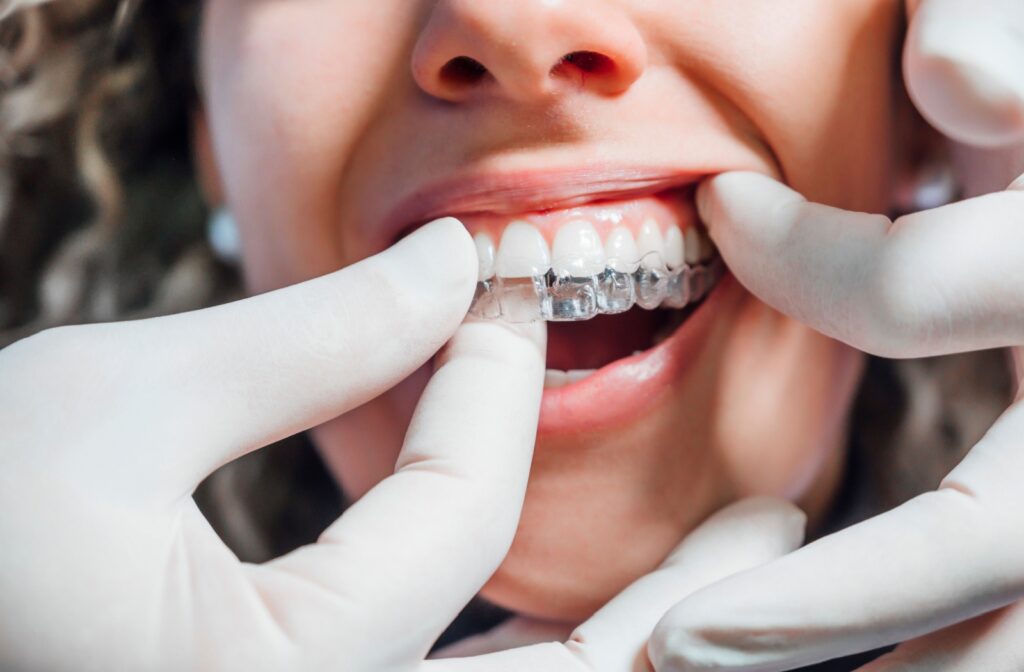 Close-up of a dental professional fitting Invisalign aligners on a patient wearing gloves