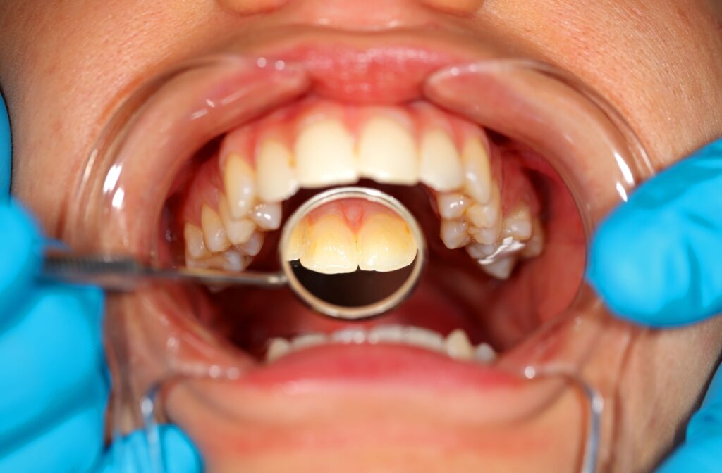 A dentist examining teeth on someone with biofilm.