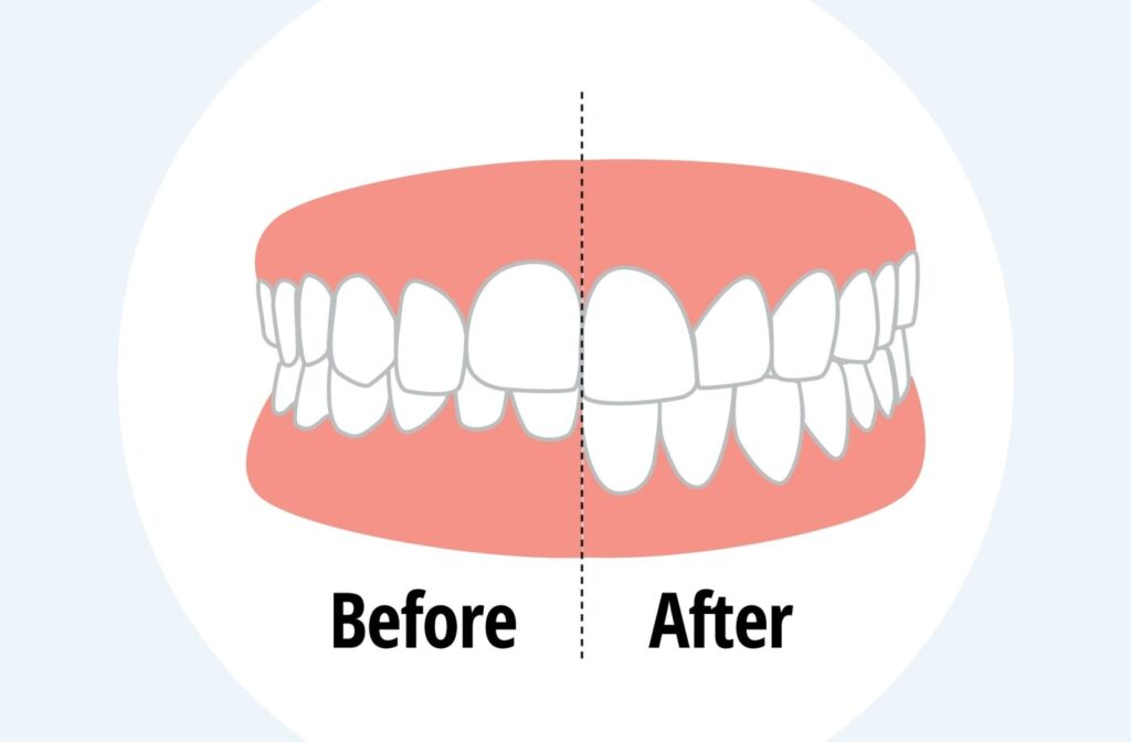 An illustration of a smile with and without an overbite, showing a before and after look at orthodontic treatment