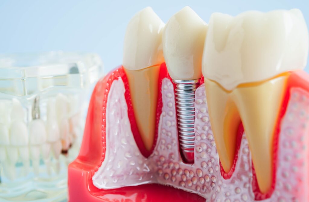 A model of a dental implant, showing the titanium root and crown